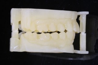Mould of bite prior to crown treatment