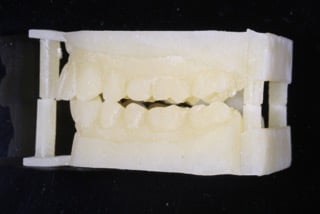 Mould of bite right side prior to crown treatment