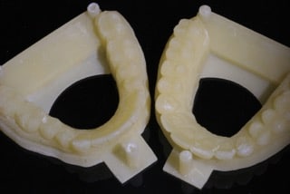 Mould of mouth prior to crown treatment