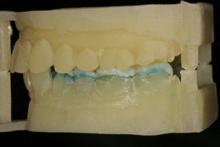OVC3 case study mould of mouth with crowns bite