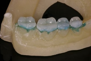 OVC3 case study mould of mouth with crowns macro