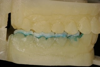 OVC3 case study mould of mouth with crowns right