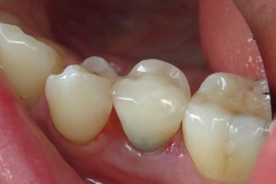 OVC3 Case Study OVC Lower Pre-Molar Endo Treated Tooth After From Side