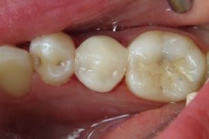 OVC3 Case Study OVC Lower Pre-Molar Endo Treated Tooth After From Top