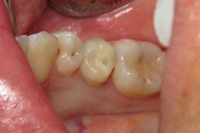 OVC3 Case Study OVC Lower Pre-Molar Endo Treated Tooth Before From Top