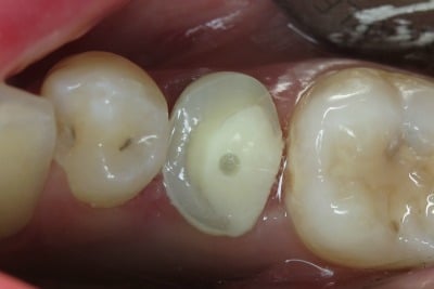 OVC Lower Pre Molar Endo Treated Tooth Prep From Top