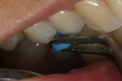 OVC Lower Pre-Molar Endo Treated Tooth Replica From Top