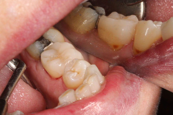 OVC3 Case study cracked tooth syndrome after from side