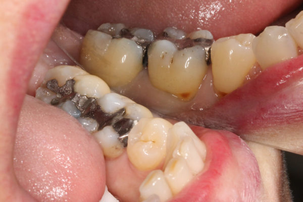 OVC3 Case study cracked tooth syndrome before from side