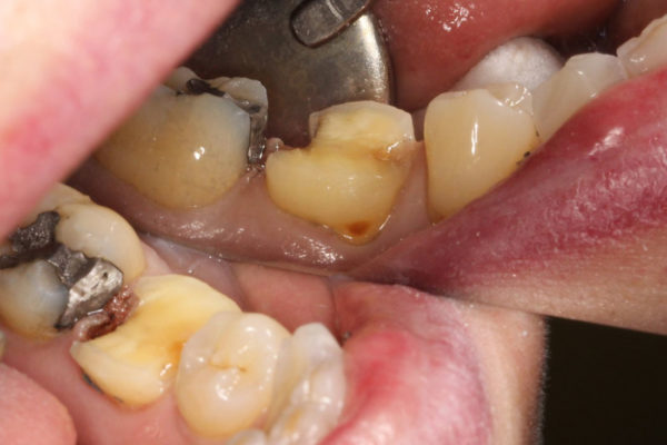 OVC3 Case study cracked tooth syndrome during crown prep from side