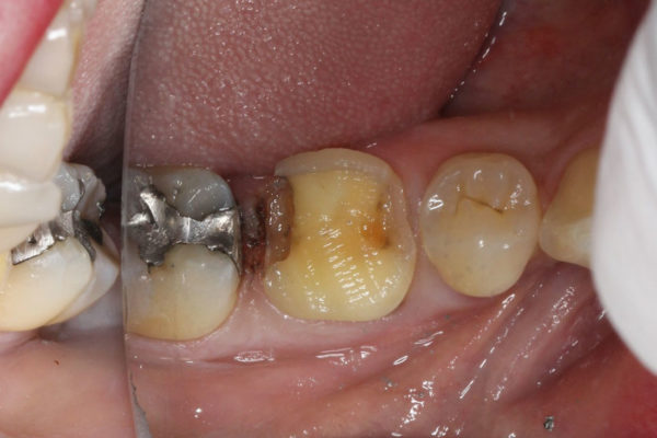 OVC3 Case study cracked tooth syndrome during crown prep from top