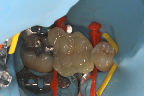 OVC3 Case study cracked tooth syndrome during crown seating from top