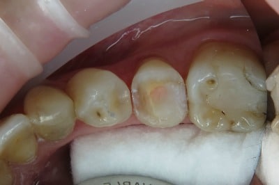 Case Study Endo Treated Pre-Molar After Prep From Top