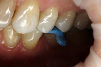 Case Study Endo Treated Pre-Molar Checking Bite With Replica From Side