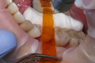 OVC3 Case Study Endo Treated Pre-Molar Sizing Using Selector Key From Side