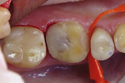 Case study OVC3 weakened molar After build up from top