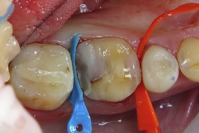 Case study OVC3 weakened molar Blue Wedge Build up from top