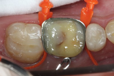Case study OVC3 weakened molar Flowable from top