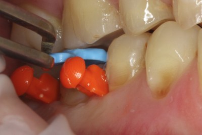Case study OVC3 weakened molar Replica Try In from top
