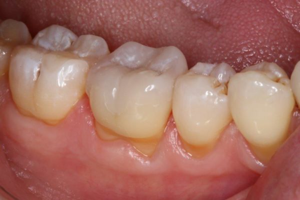 OVC3 Case study treating patient cracked tooth syndrome one visit after from side