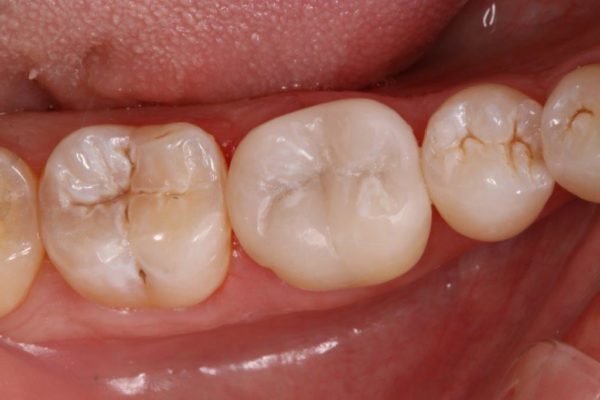 OVC3 Case study treating patient cracked tooth syndrome one visit after from top
