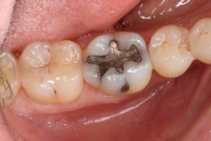 OVC3 Case study treating patient cracked tooth syndrome one visit before from top