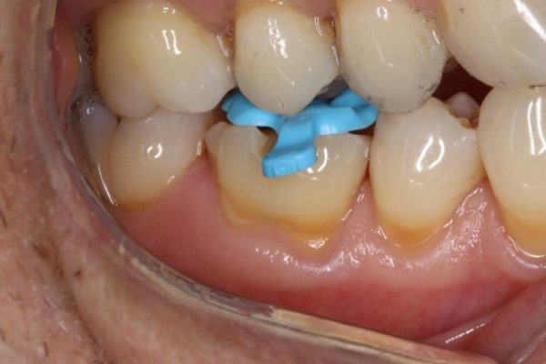 OVC3 case study treating patient cracked tooth syndrome one visit during from side with replica