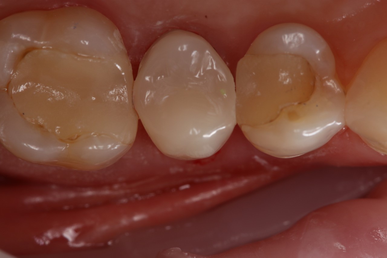 OVC3 Case study very little remaining tooth structure after from bottom
