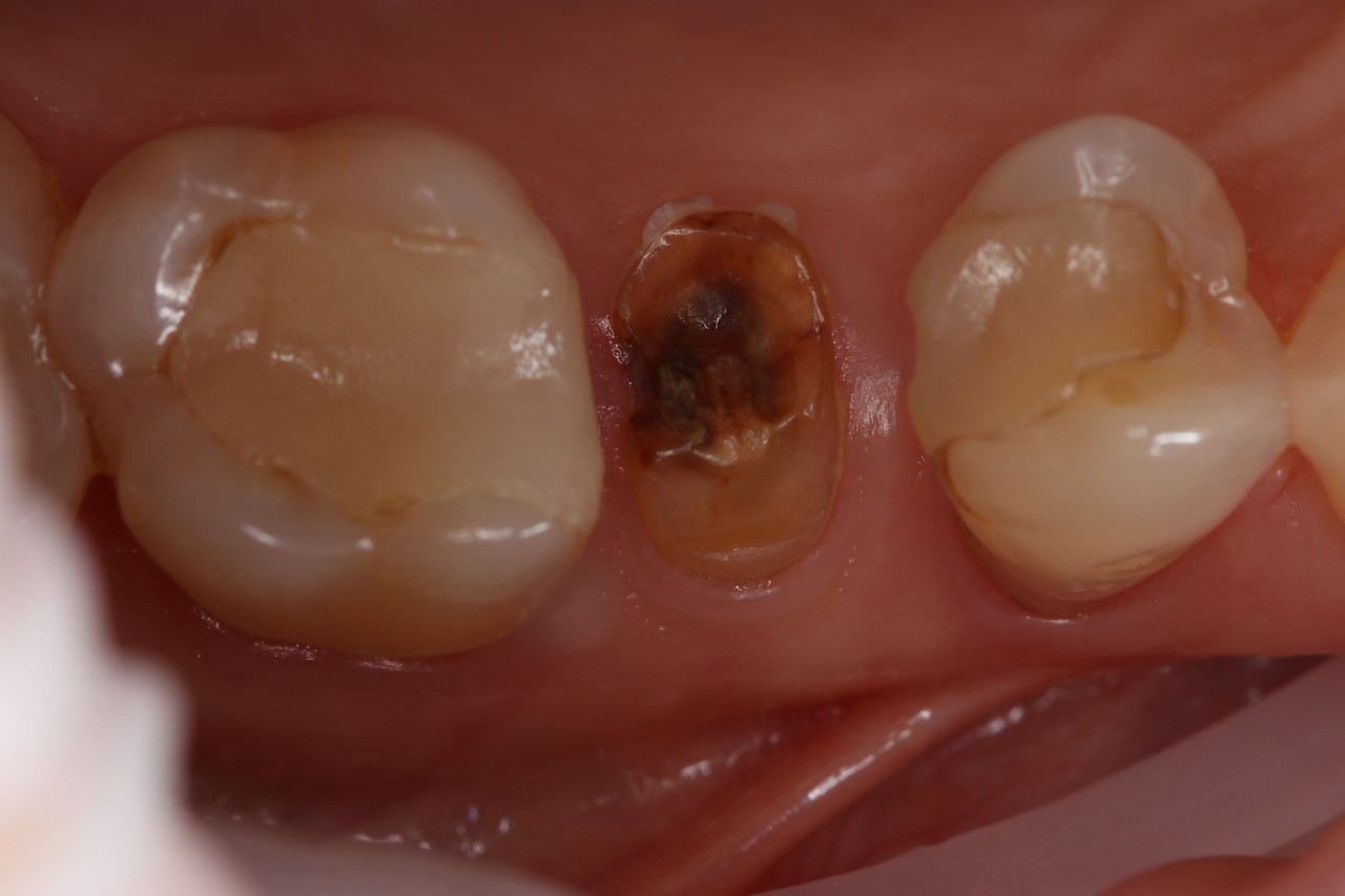 OVC3 Case study very little remaining tooth structure before from top