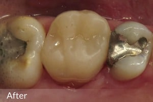 OVC3 case study after occlusal