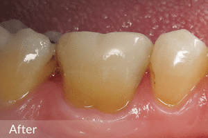 OVC3 case study after restoration on amalgam filled tooth