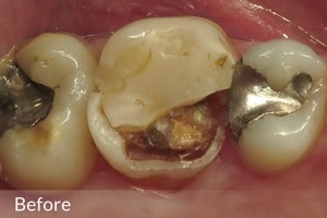 OVC3 case study before occlusal