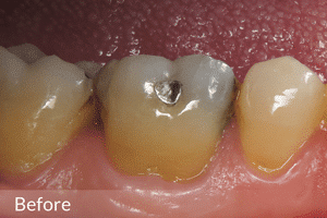 OVC3 case study before restoration on amalgam filled tooth