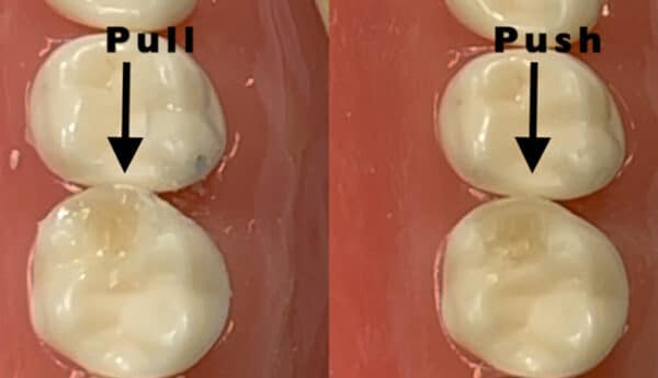 Figure 6. The image on the left shows a wider contact point created by pulling on the tab of the matrix and the image on the right shows the same cavity created using the push technique.
